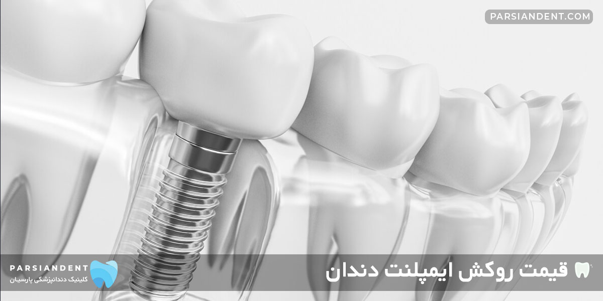 قیمت روکش ایمپلنت دندان