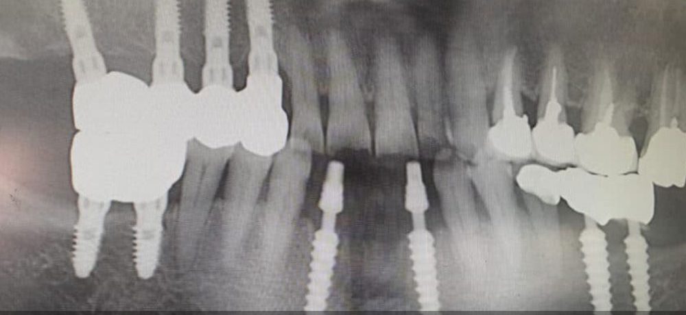 مزایای ایمپلنت دندان یک تکه