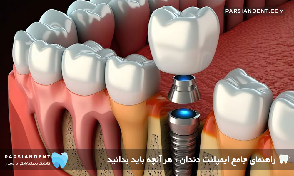 راهنمای ایمپلنت دندان