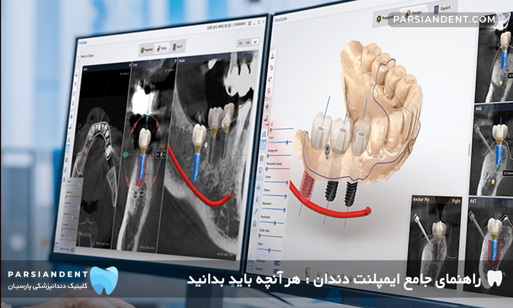ایمپلنت دیجیتال تهران