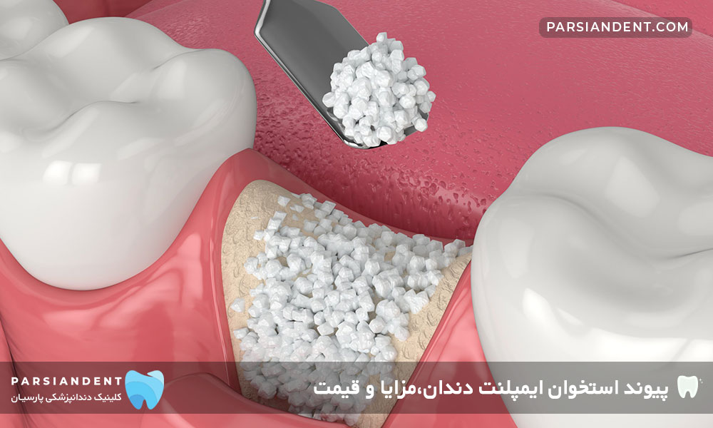 پیوند استخوان ایمپلنت دندان