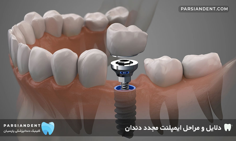 ایمپلنت مجدد دندان