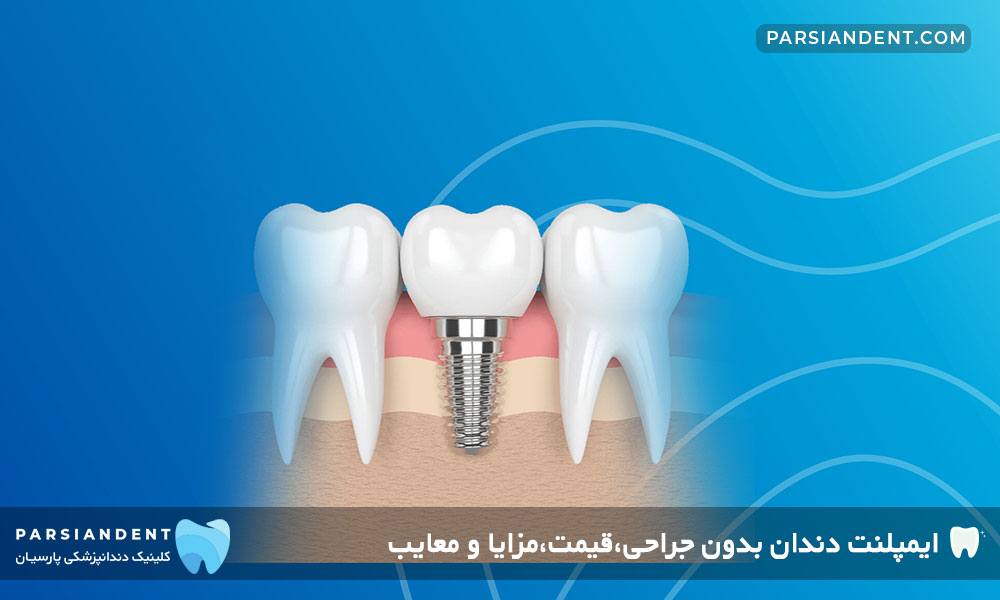 ایمپلنت دندان بدون جراحی