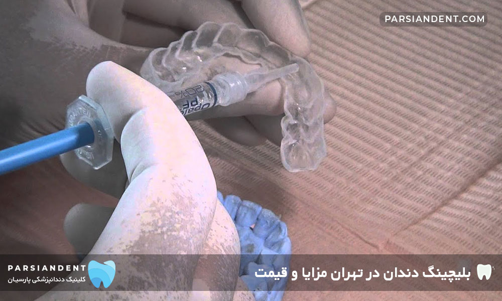 بلیچینگ دندان در منزل Home Bleaching