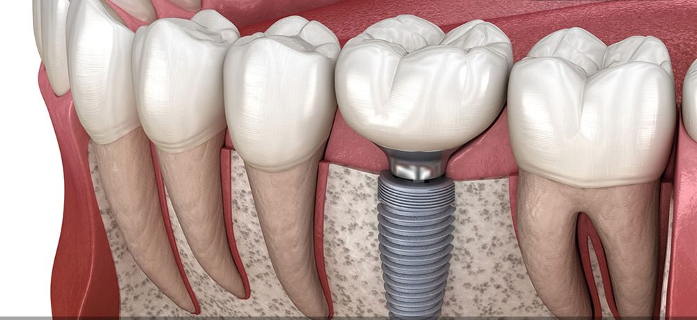 ایمپلنت دندان اقساطی تهران