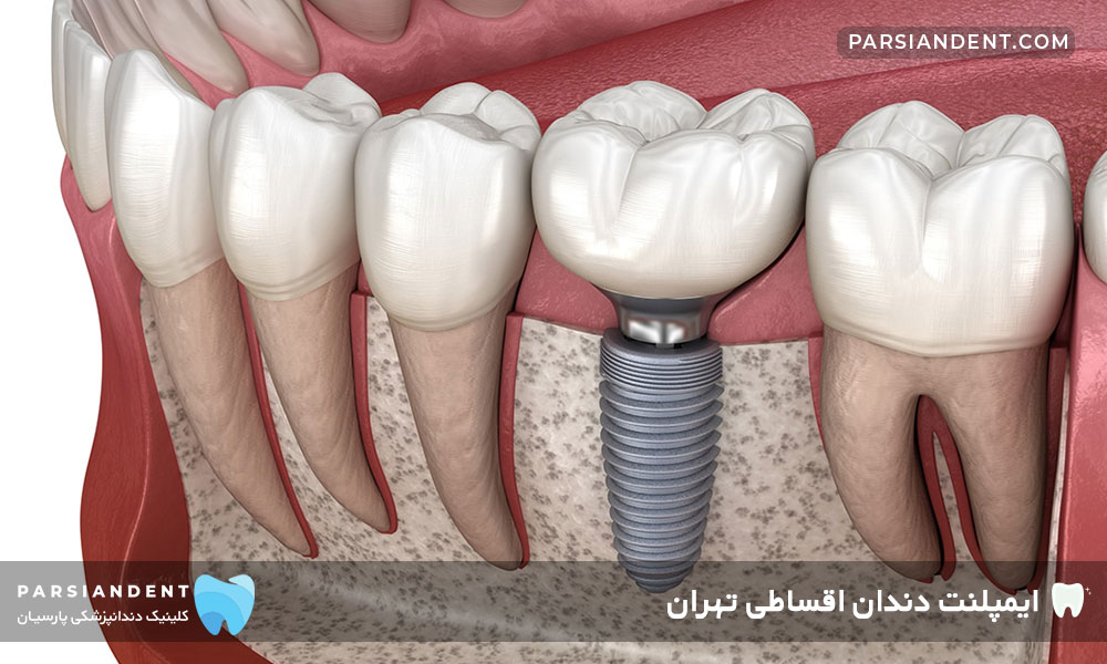 ایمپلنت دندان اقساطی تهران