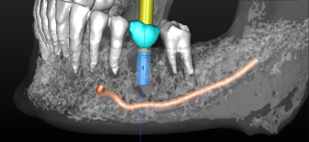 تفاوت ایمپلنت دیجیتال با ایمپلنت معمولی