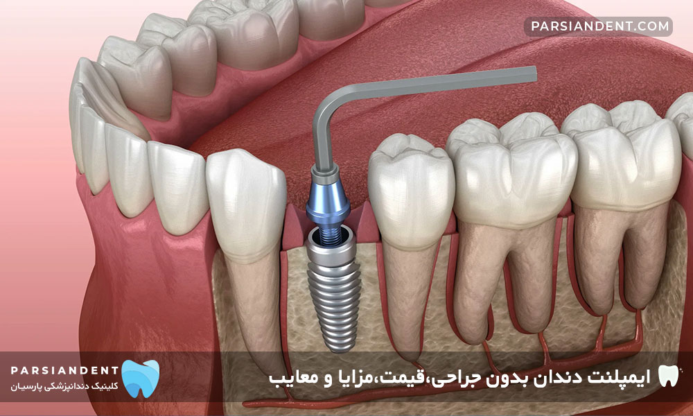 ایمپلنت دندان بدون جراحی