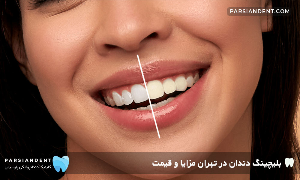 بلیچینگ دندان