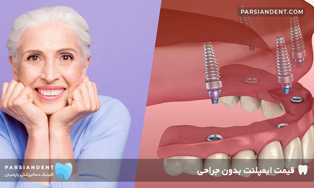 قیمت ایمپلنت بدون جراحی
