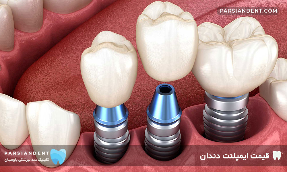 قیمت ایمپلنت دندان