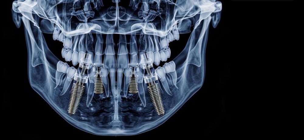 قیمت ایمپلنت دیجیتال