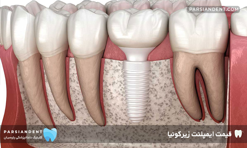 قیمت ایمپلنت زیرکونیا