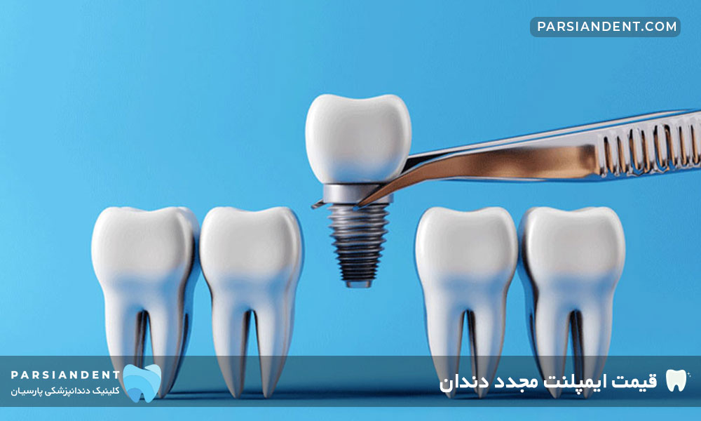 قیمت ایمپلنت مجدد دندان