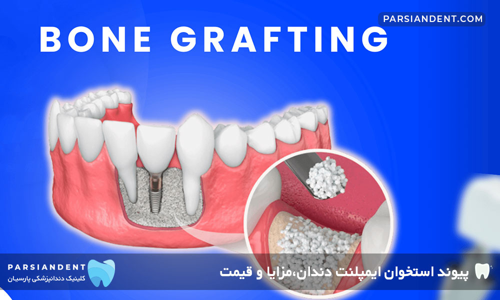 قیمت پیوند استخوان ایمپلنت