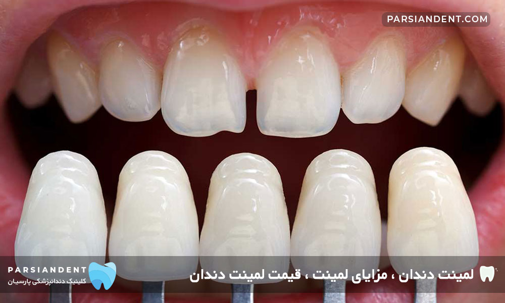 مزایا و معایب لمینت دندان