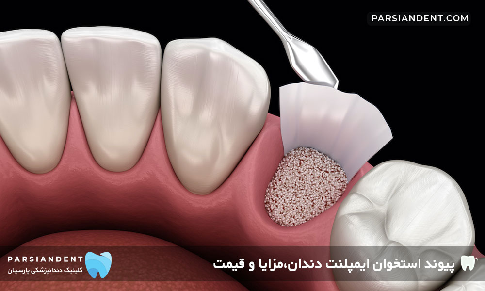 پیوند استخوان ایمپلنت دندان،مزایا و قیمت