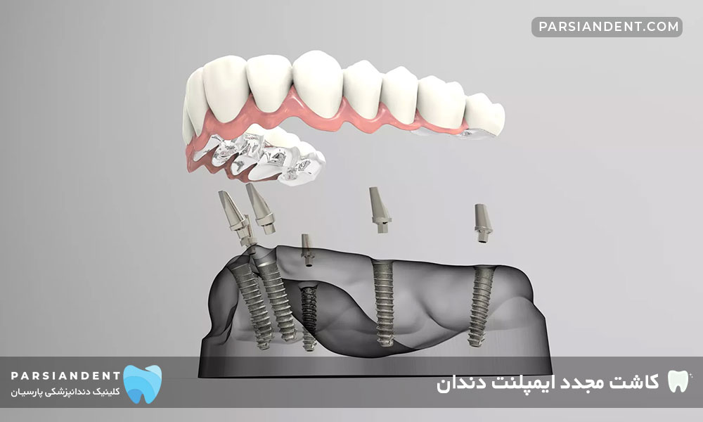 کاشت مجدد ایمپلنت دندان