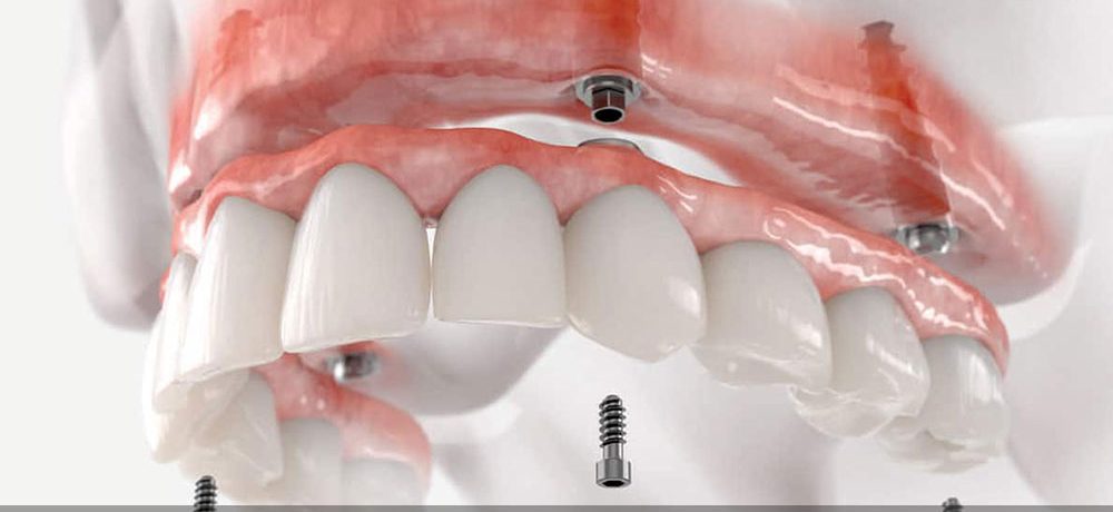 چسب ایمپلنت دندان
