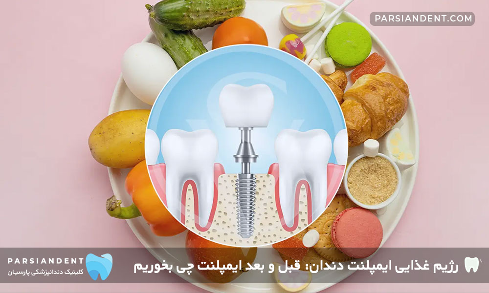 رژیم غذایی ایمپلنت دندان