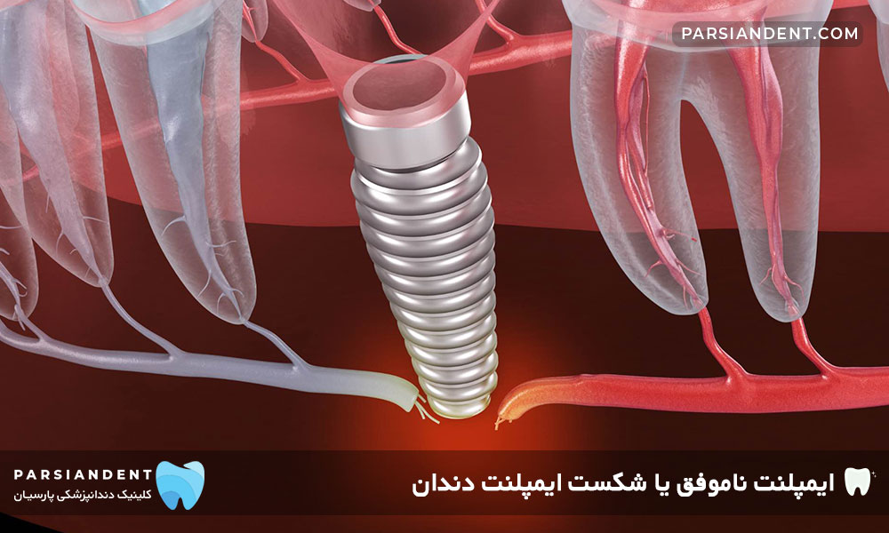 شکست ایمپلنت دندان