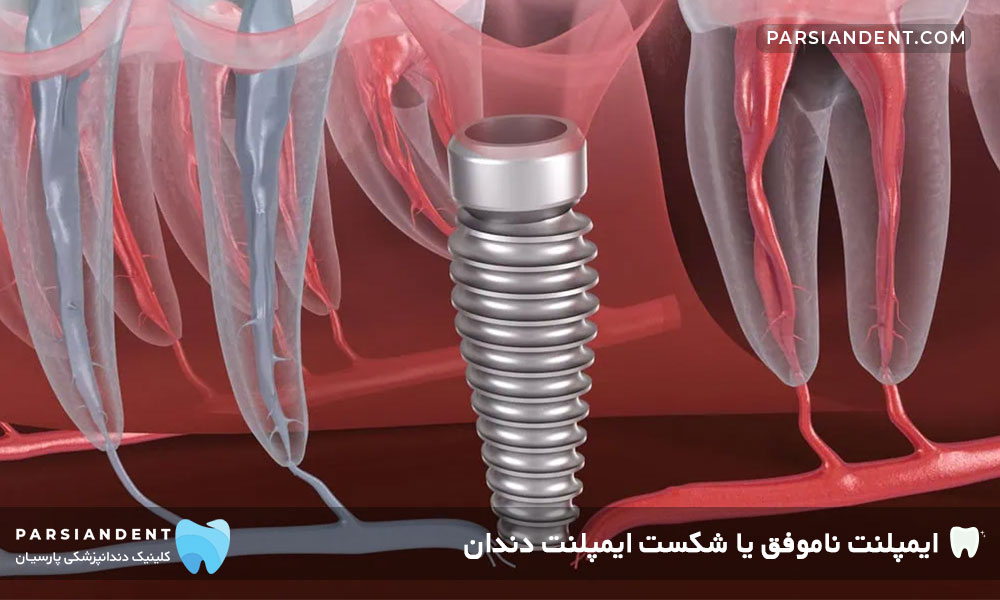 ایمپلنت ناموفق یا شکست ایمپلنت دندان