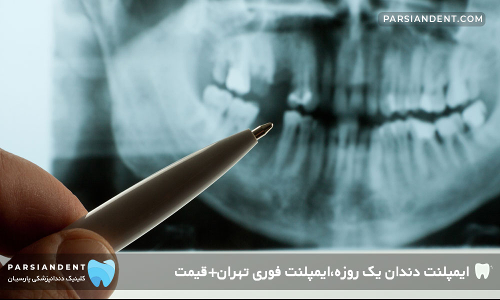 قیمت ایمپلنت دندان یک روزه