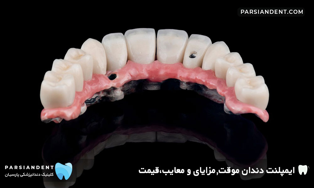 ایمپلنت دندان موقت