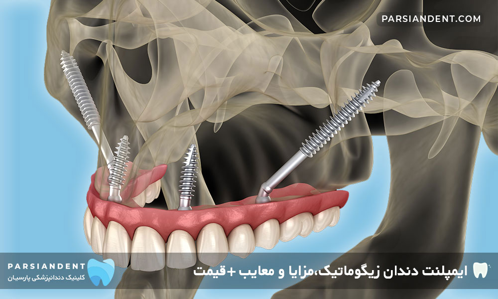 ایمپلنت دندان زیگوماتیک