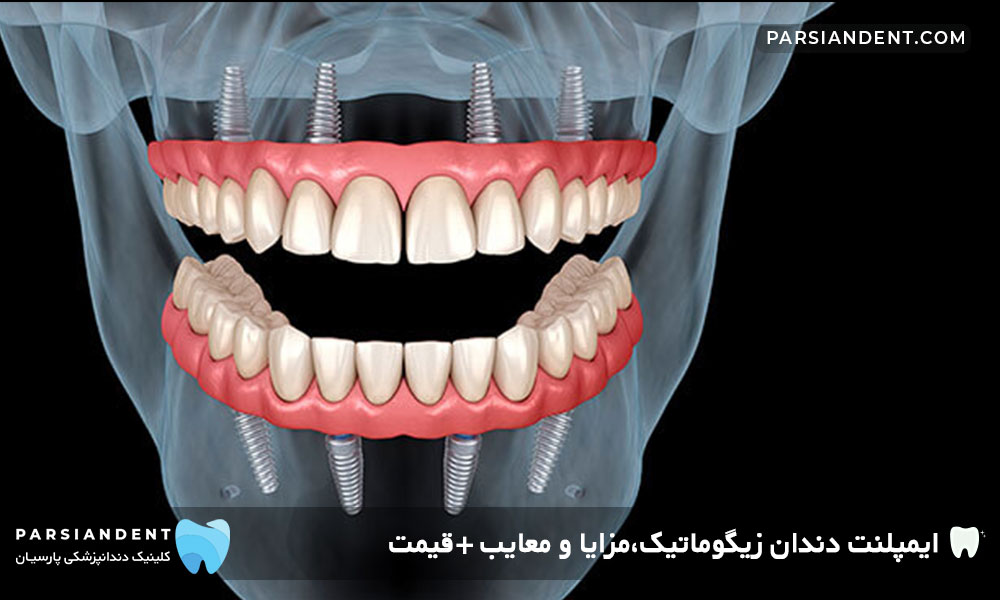 قیمت ایمپلنت دندان زیگوماتیک