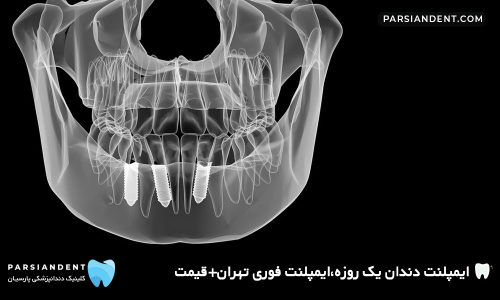 ایمپلنت دندان یک روزه