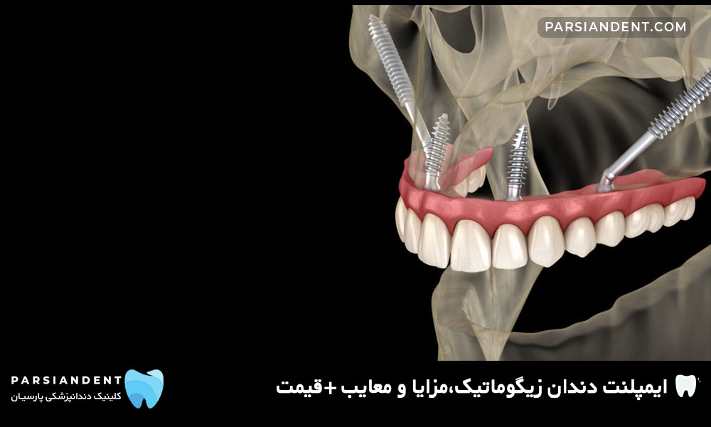ایمپلنت دندان زیگوماتیک