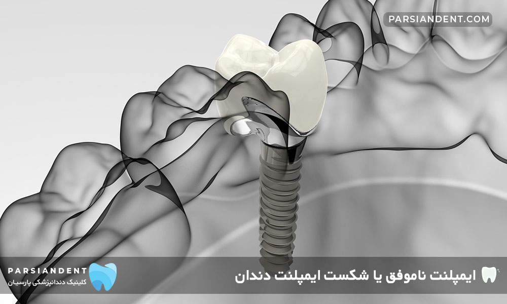 ایمپلنت ناموفق دندان