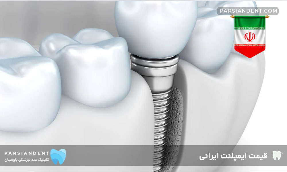 قیمت ایمپلنت ایرانی دندان