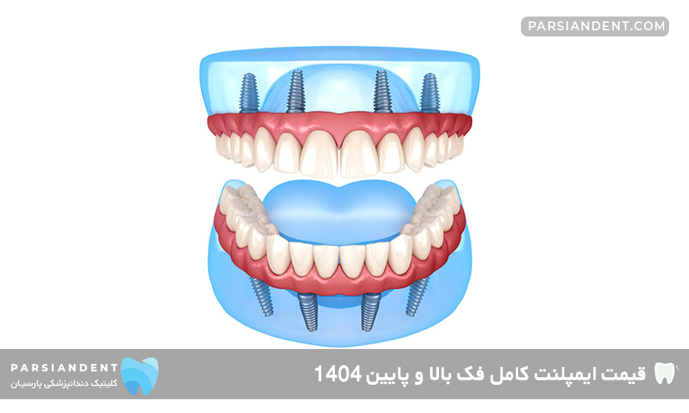 قیمت ایمپلنت کامل فک بالا و پایین 1404