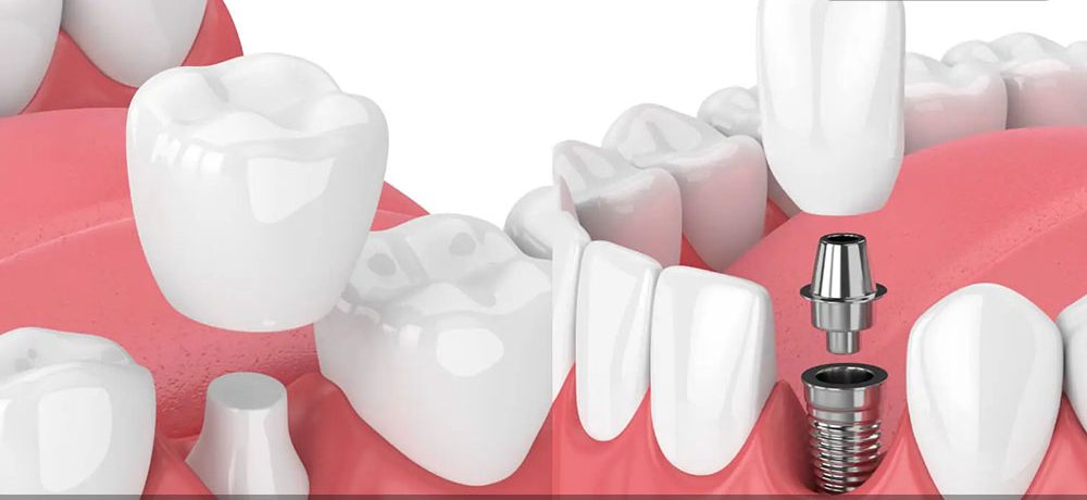 روکش موقت ایمپلنت دندان