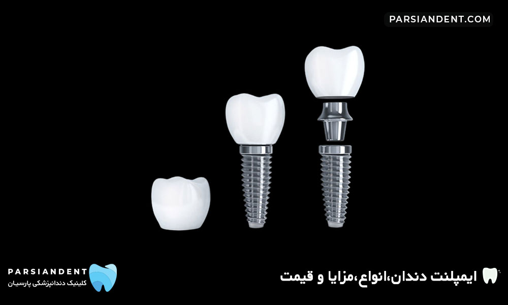 قیمت ایمپلنت دندان