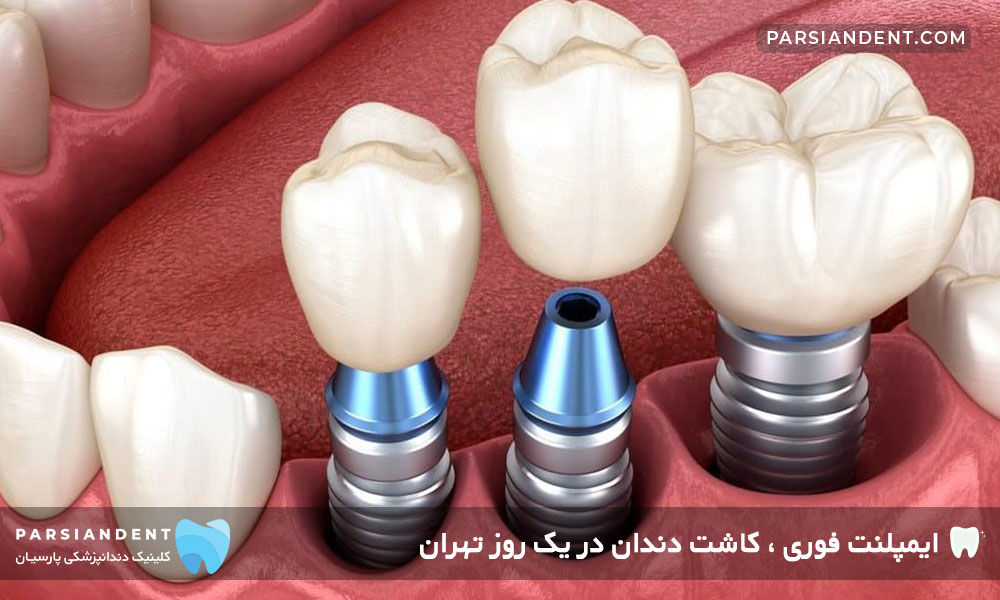 ایمپلنت فوری ، کاشت دندان در یک روز تهران