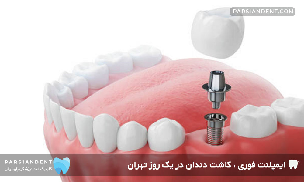 ایمپلنت فوری ، کاشت دندان در یک روز تهران