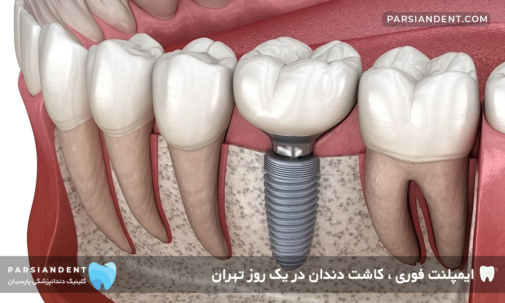 ایمپلنت فوری