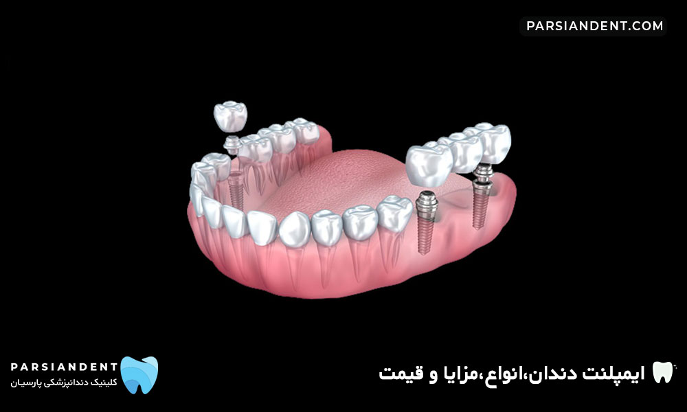 ایمپلنت دندان،انواع،مزایا و قیمت