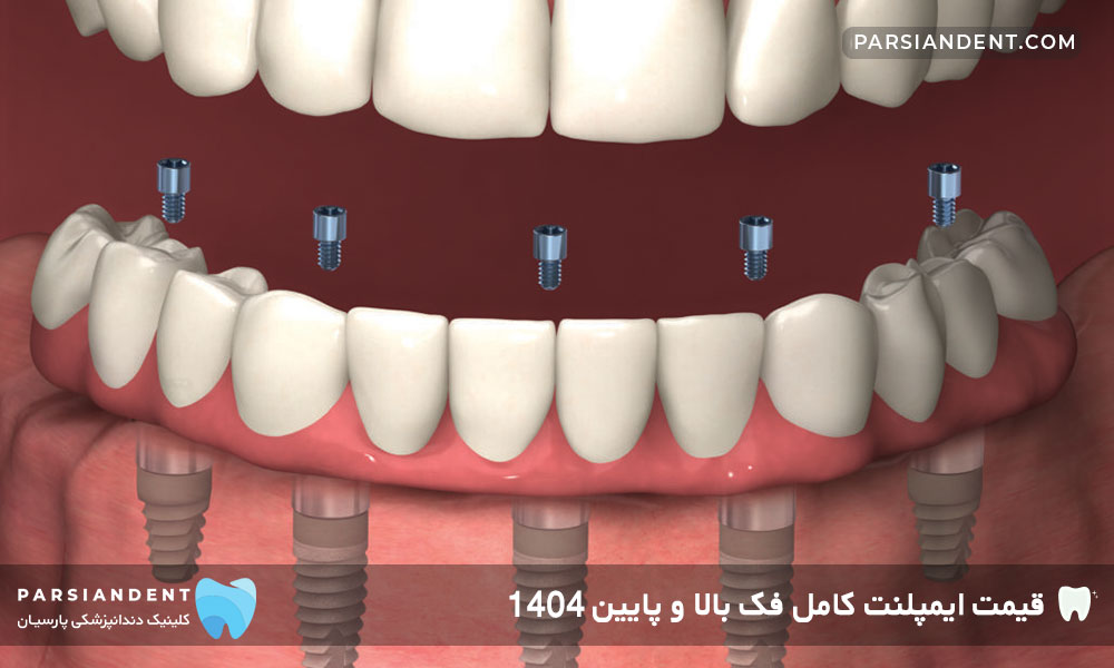 قیمت ایمپلنت کامل فک بالا و پایین