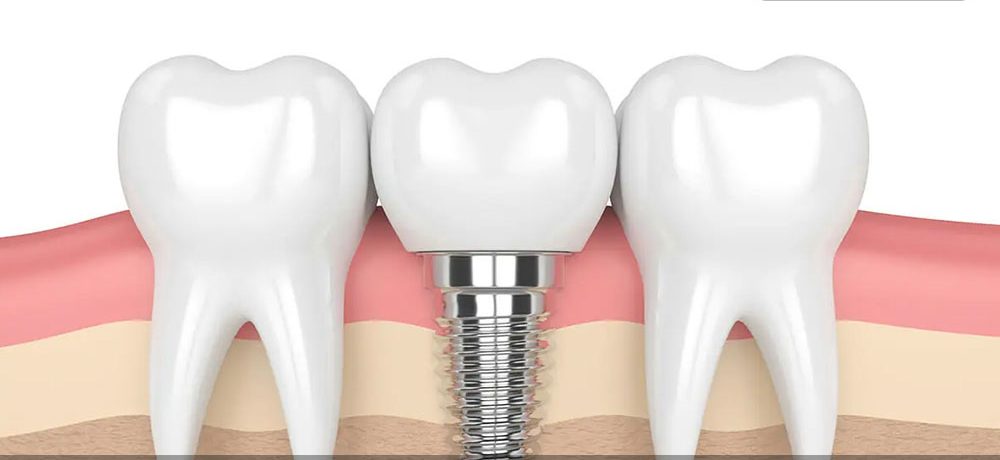 قیمت روکش موقت ایمپلنت دندان