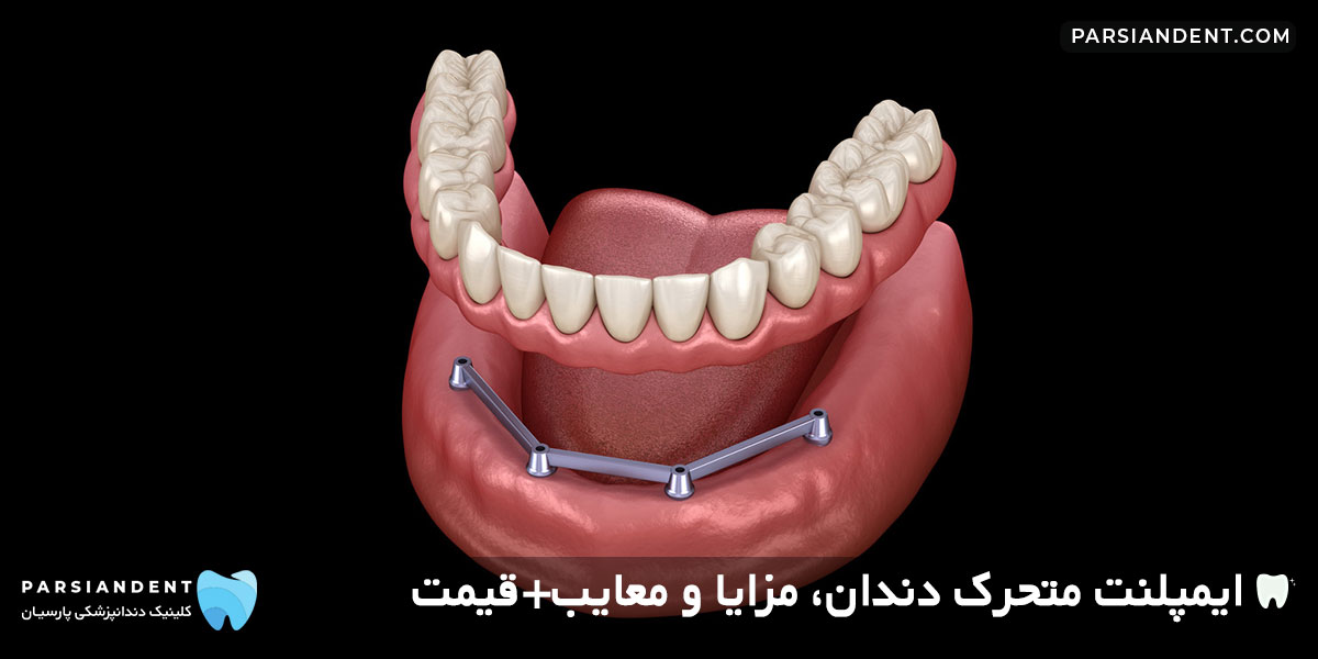 ایمپلنت متحرک دندان