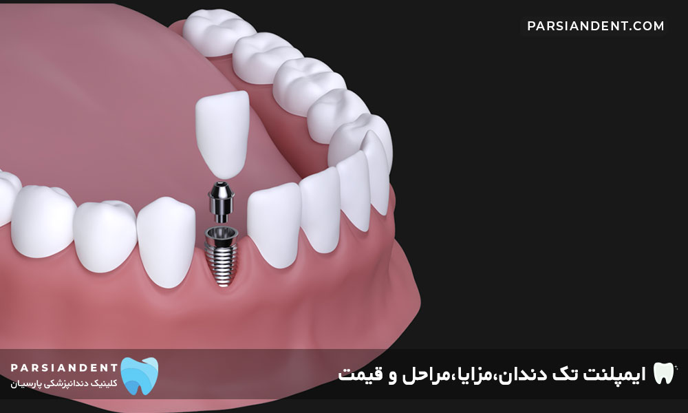 قیمت ایمپلنت تک دندان