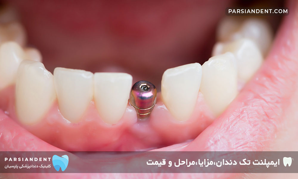 ایمپلنت تک دندان،مزایا،مراحل و قیمت