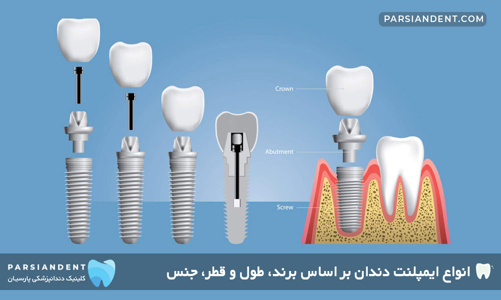 انواع ایمپلنت دندان