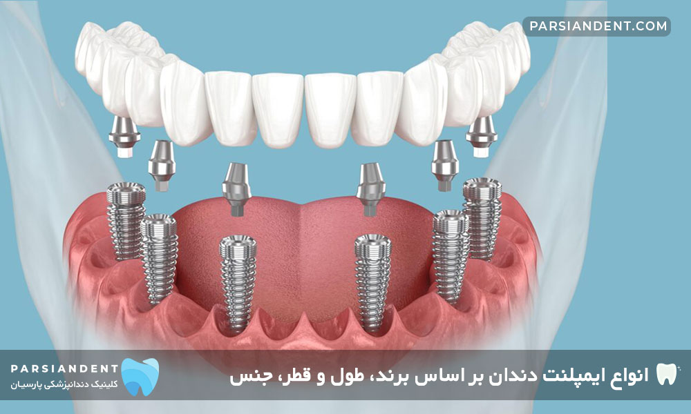 بهترین نوع ایمپلنت دندان