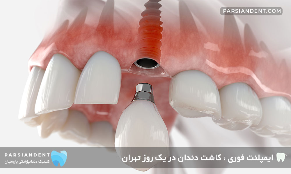 بارگذاری فوری (immediate loading)
