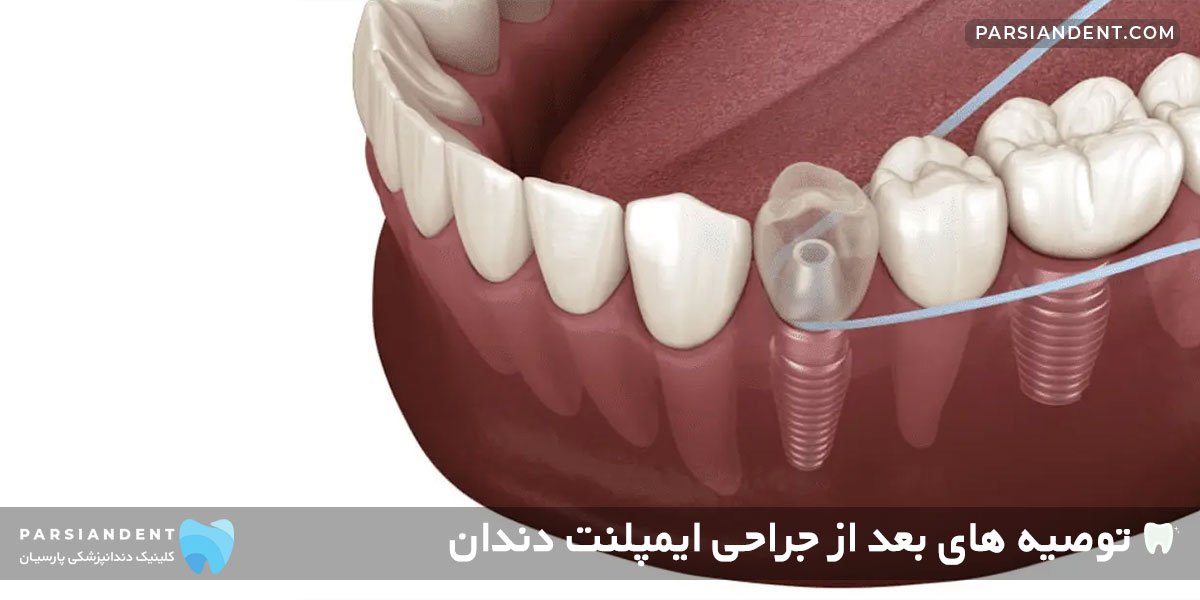 توصیه های بعد از جراحی ایمپلنت دندان